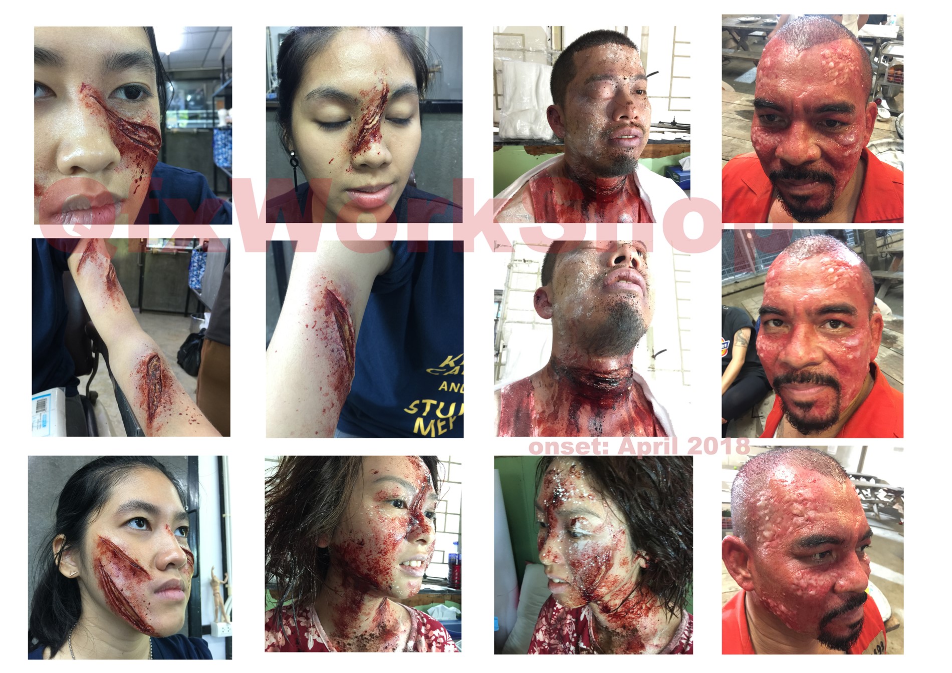HK injury